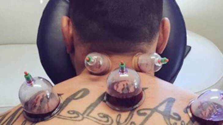 Treatment: Sonny Bill Williams receives hijama cupping therapy. Photo: Twitter:@SonnyBWilliams
